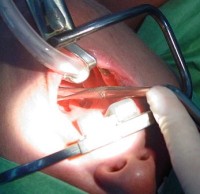 A Tonsillectomy, as I know *everyone* likes looking at pictures of surgery...